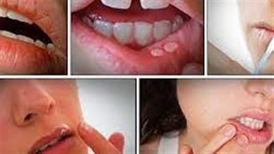 حقائق عن العلكة ! هل تنقص الوزن ؟ هل تقوي الأسنان ؟ 